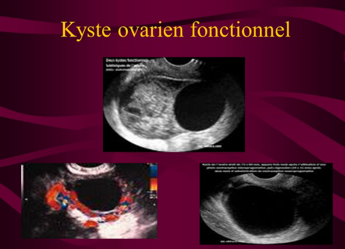 Les différentes sortes de kystes ovariens Adrhess